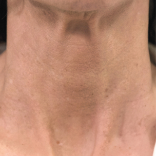 Profhilo-neck-1-After