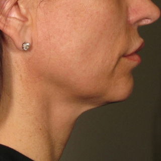 Ultherapy-Hals-AFTER