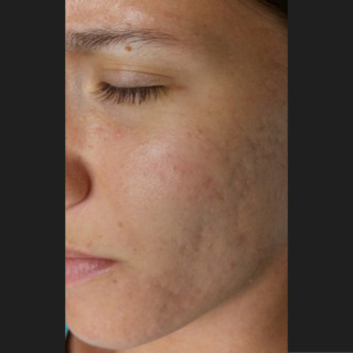 Skinpen-akne-efter2