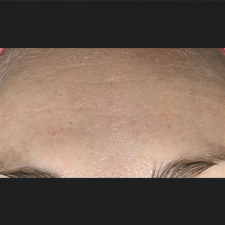 Skinpen-rynker-efter1