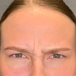 cerix-web-glabella-før
