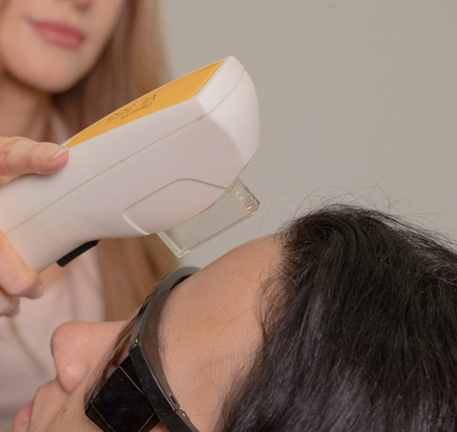 Cerix-klinik: En erfaren behandler holder et håndholdt laserapparat mod patientens pande og hårgrænse under ansigtsbehandling. Patienten har beskyttelsesbriller på i et lyst klinisk behandlingsrum. Billedet viser en skånsom, ikke-invasiv laserbehandling til hårfjerning og hudforbedring i ansigtet professionelt udført af Cerix.