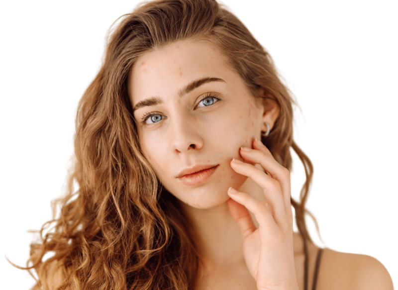 Nærbillede af en ung kvinde med krøllet hår og blå øjne, der blidt rører ved sin kind. Hendes ansigt viser tydelige tegn på akne og uren hud. Dette billede illustrerer hudproblemer, der kan afhjælpes med professionel aknebehandling og hudpleje hos Cerix for en renere hud i ansigtet.