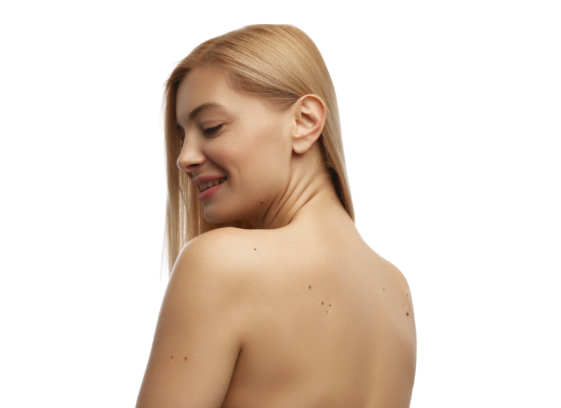 Her er et forslag til en ALT-tekst på dansk, der opfylder dine kriterier: En blond kvinde set skråt bagfra smiler og viser sin bare skulder, nakke og øvre ryg med synlige modermærker mod en hvid baggrund. Billedet illustrerer fokusområder for Cerix, der tilbyder kosmetiske hudbehandlinger til krop og ansigt, herunder hudforyngelse på ryggen eller potentielt fjernelse af modermærker.