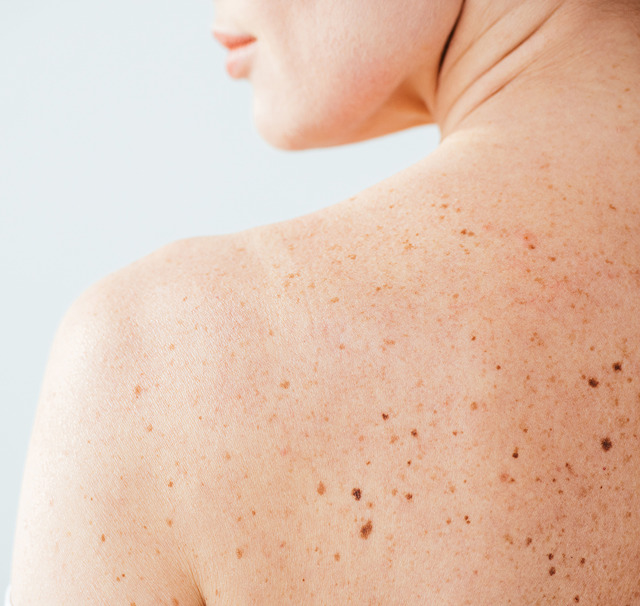 Nærbillede af en kvindes skulder og øvre ryg med mange fregner og modermærker i forskellige størrelser. Cerix tilbyder konsultation, hudtjek og modermærkefjernelse (f.eks. kirurgisk eller laser) til behandling af hudforandringer. Billedet viser området, hvor dermatologisk vurdering og behandling kan finde sted.