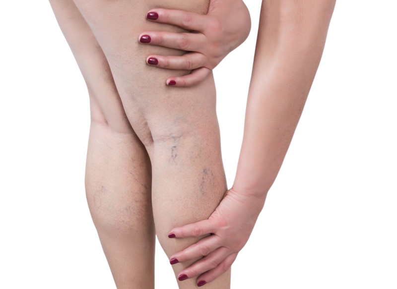 Nærbillede af en kvindes ben på en hvid baggrund, hvor hun med hænderne holder om læggen. Billedet viser tydelige karsprængninger og synlige blå blodårer på huden, hvilket er en tilstand, der kan behandles effektivt hos Cerix med specialiserede metoder til fjernelse af karsprængninger på ben.